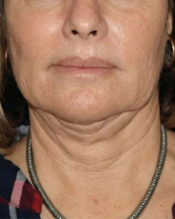 pesoperdido-3-ANTES.jpg